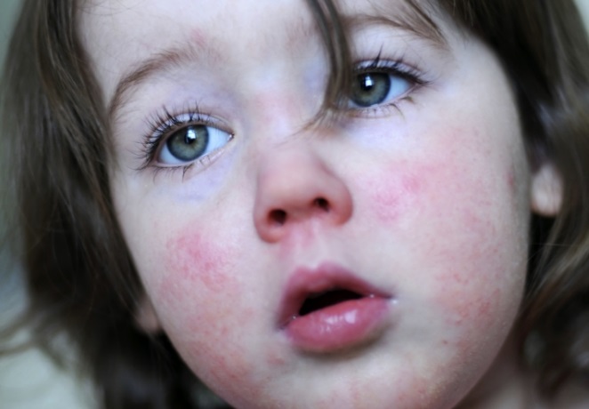 Scarlet fever cases continue to rocket in Reading and surrounding towns