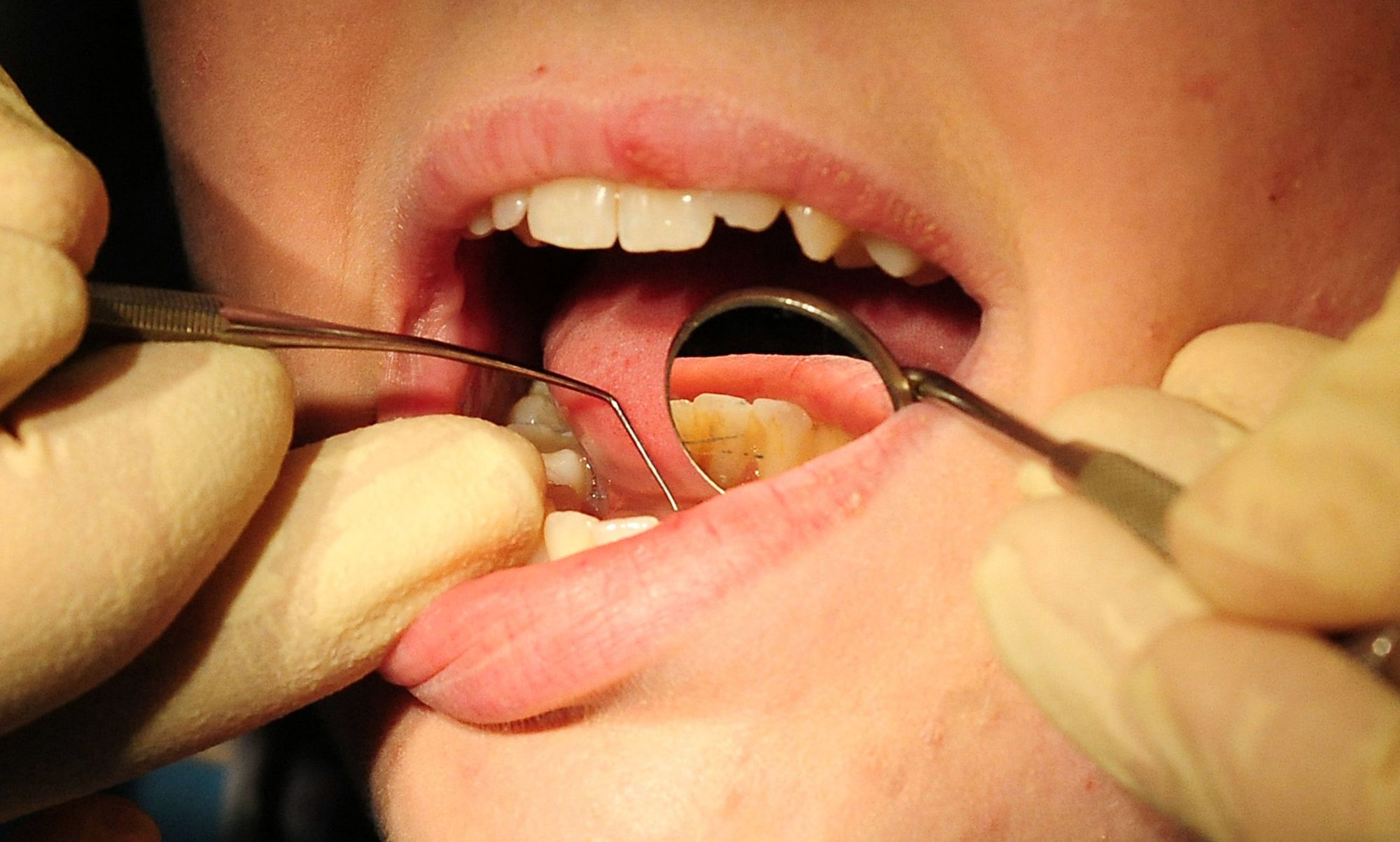 Thousands of dentists stop providing NHS services