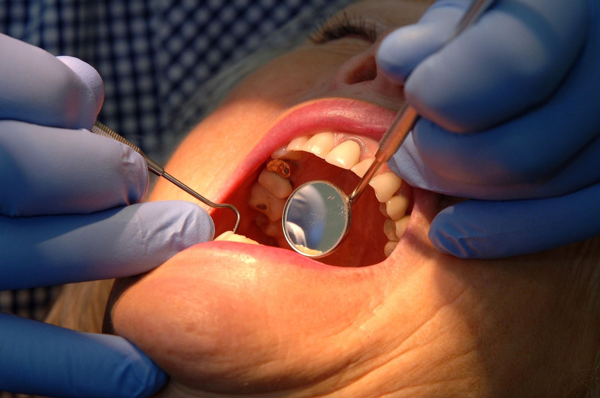 People forced to pull out own teeth as NHS dental access crisis deepens
