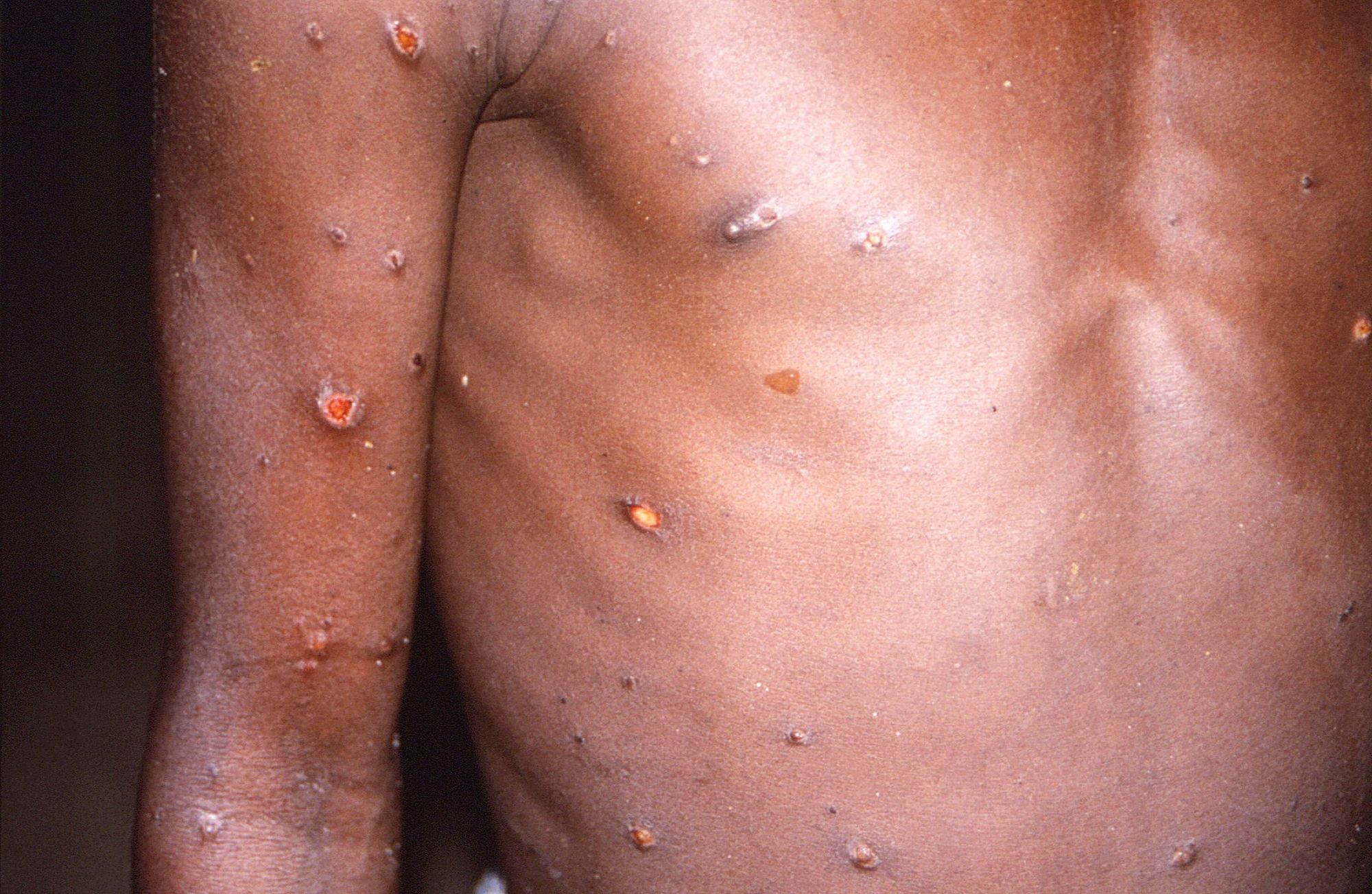 New monkeypox strain identified in UK