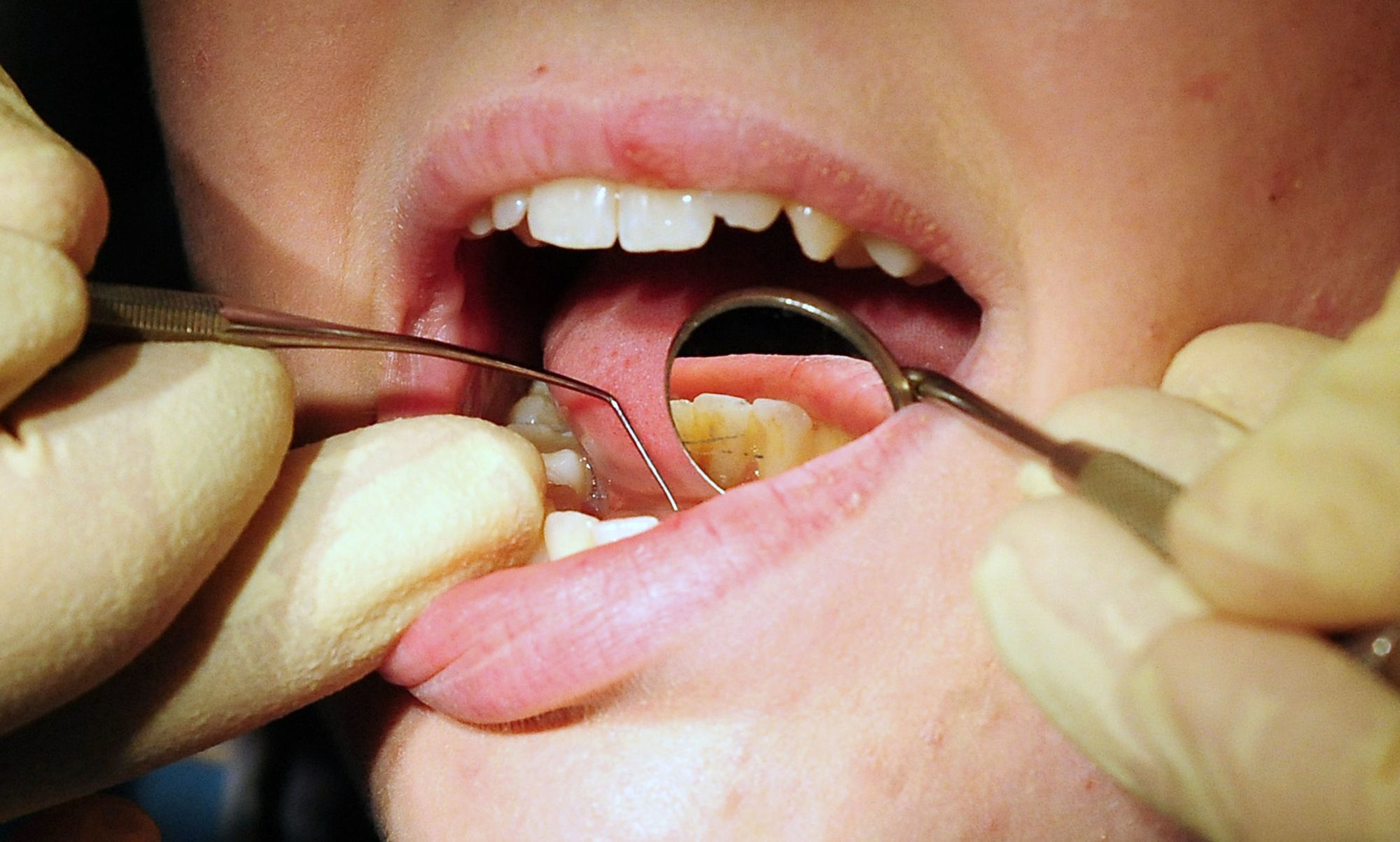 NHS dental charges set to rise