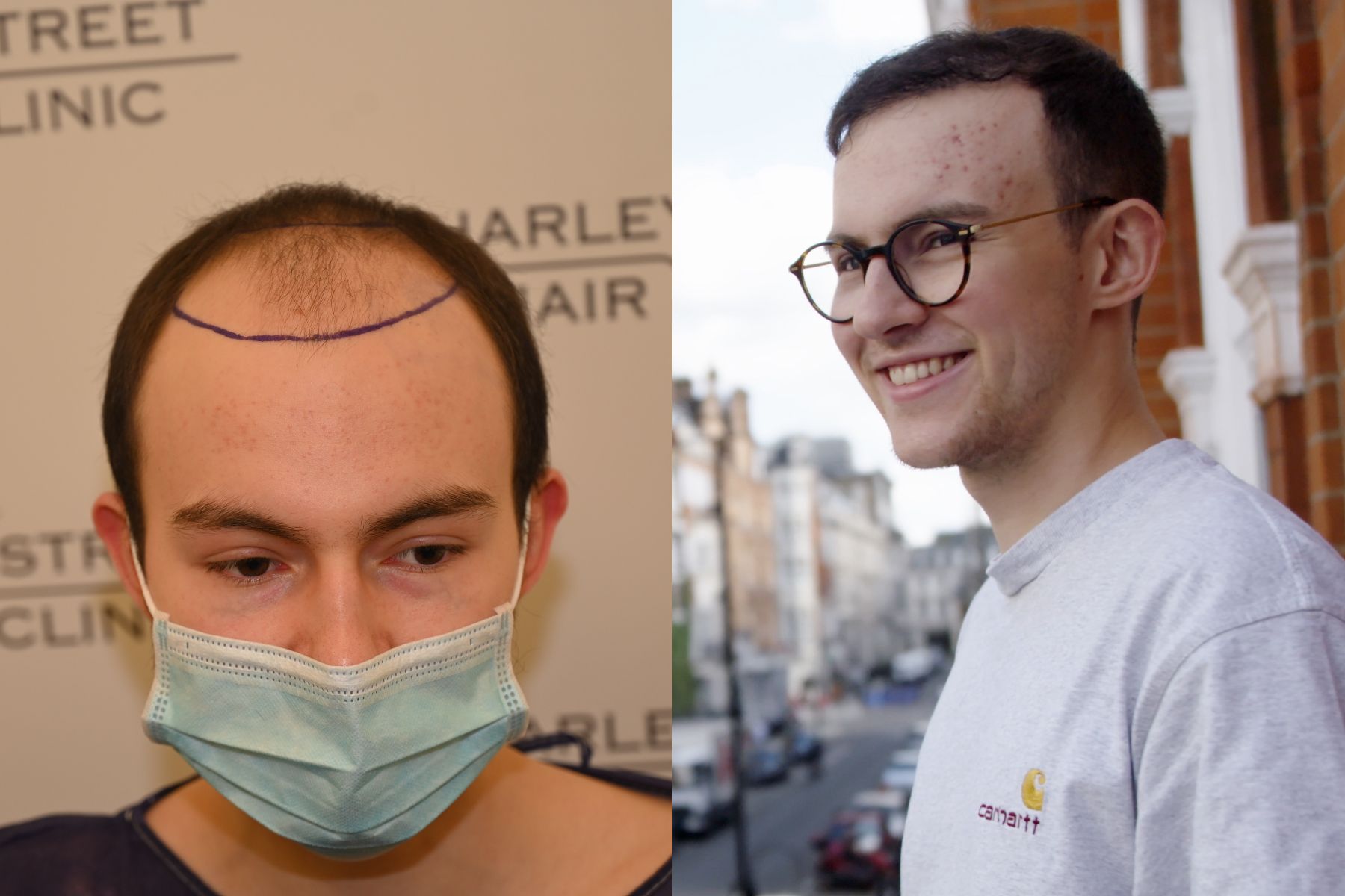 Hair transplant restores confidence of young student battling depression and social anxiety