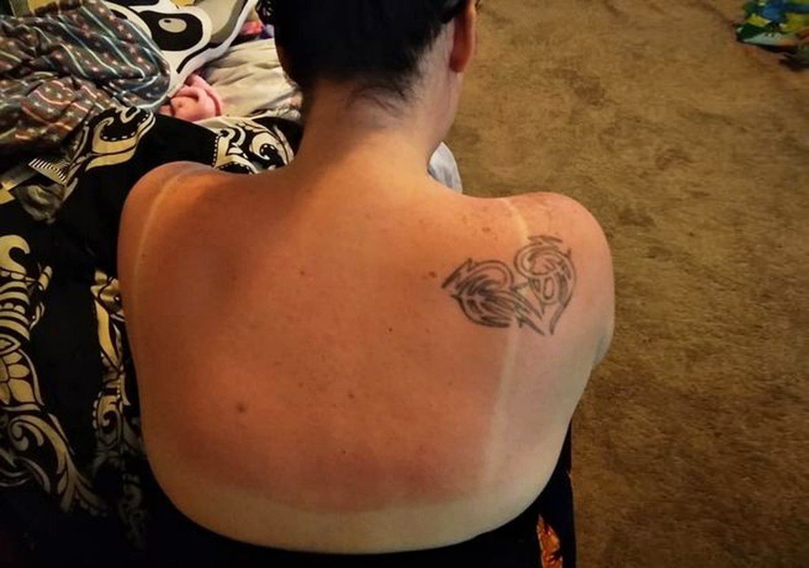 Ease sunburn in just 30 minutes with surprising household product hailed as a ‘godsend’
