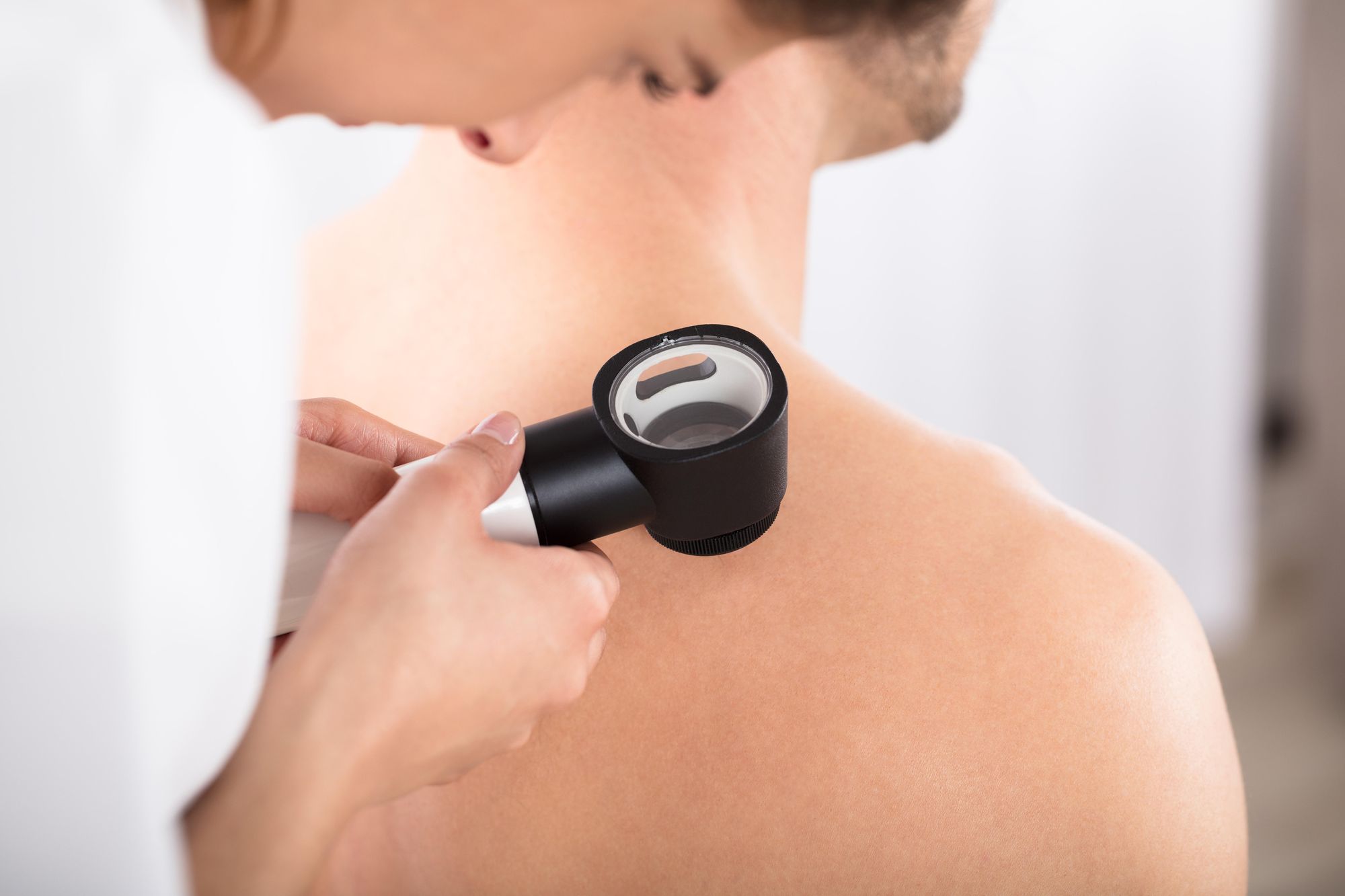 Understanding melanoma - the signs, symptoms and treatment