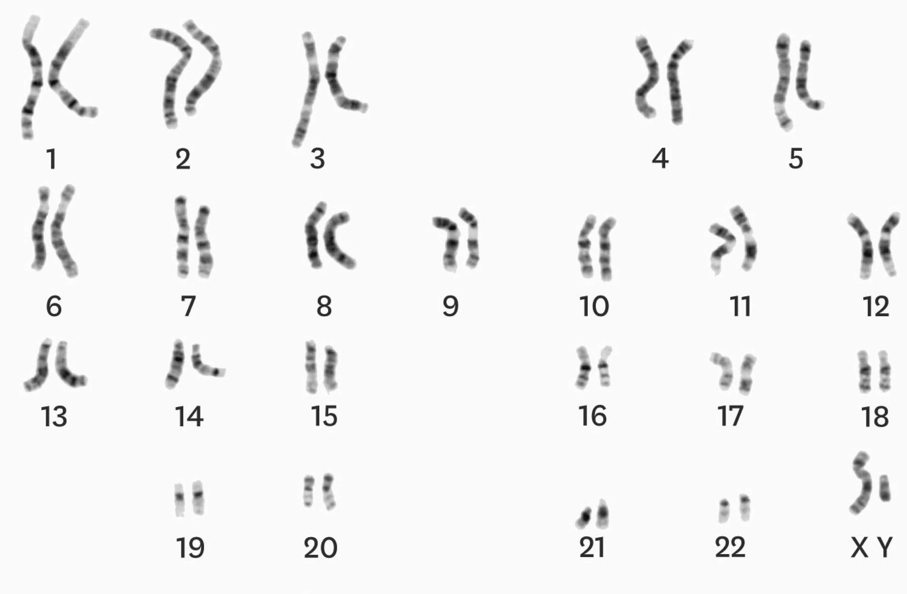 le-caryotype-d-une-cellule-uf-issue-de-la-f-condation
