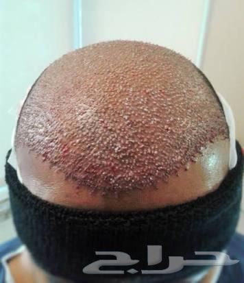 زراعه شعر واللحيه في اسطنبول