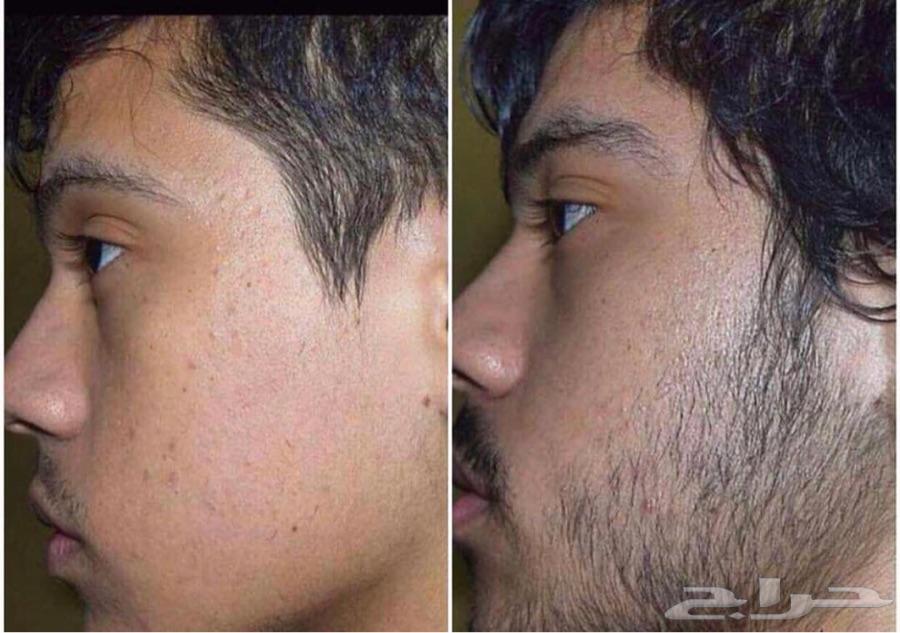 افضل زيت لاطالة الدقن والفرغات
