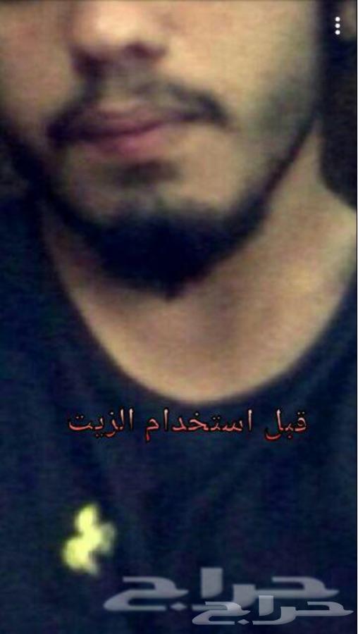 تعاني تساقط الشعر او فرغات الذقن و الصلع