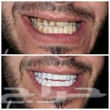 ابتسامة الفينير المتحركة