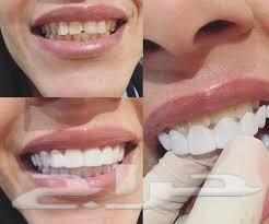 ابتسامة الفينير المتحركة