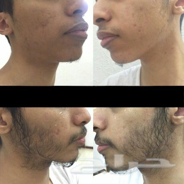 نظرا لطلبكم مددنا العررض يومين الزيت الافغاني