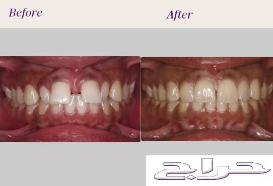 تقويم الاسنان الطبي بارخص الاسعار