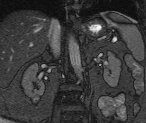 MRI  adrenal glands  t2 trufi  breath hold coronal 