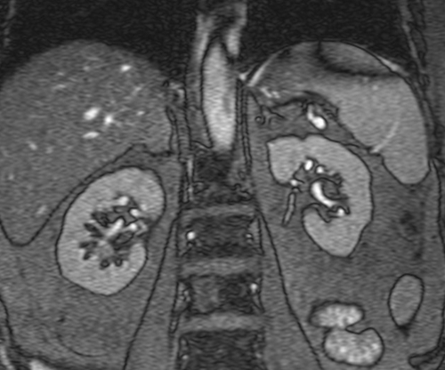 MRI  adrenal glands  t2 trufi  breath hold coronal 