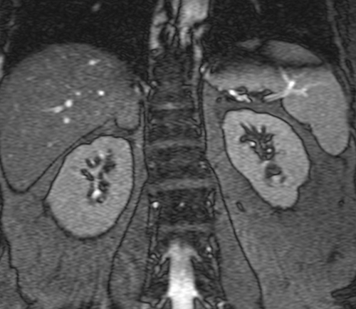 mri adrenal t2 trufi  breath hold coronal 