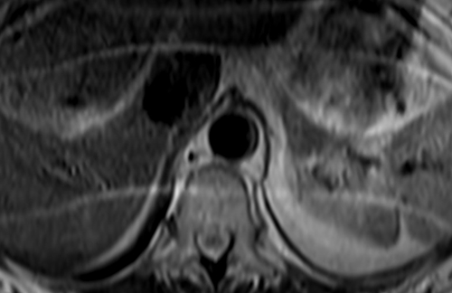 MRI  adrenal glands  t2 tse breath hold axial 