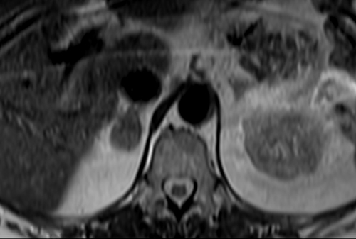 MRI  adrenal glands  t2 tse breath hold axial 