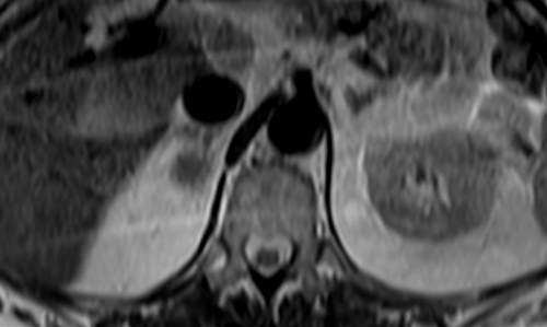 mri adrenal t2 tse breath hold axial 