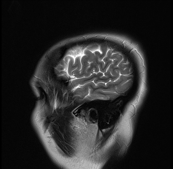 T2 MRI brain sagittal image 1