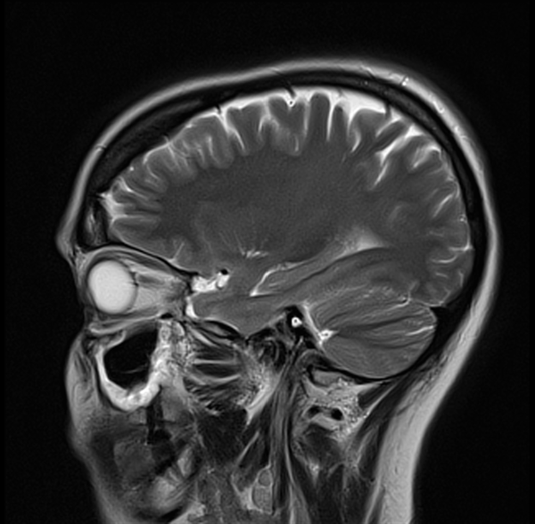 T2 MRI brain sagittal image 2