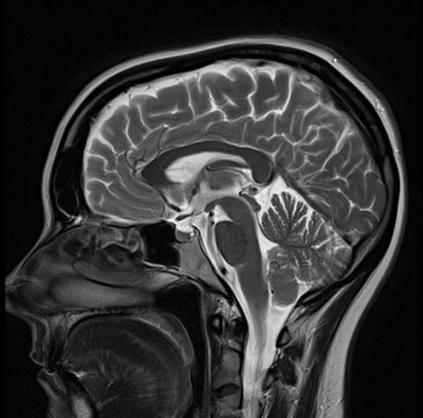 T2 MRI brain sagittal image 3