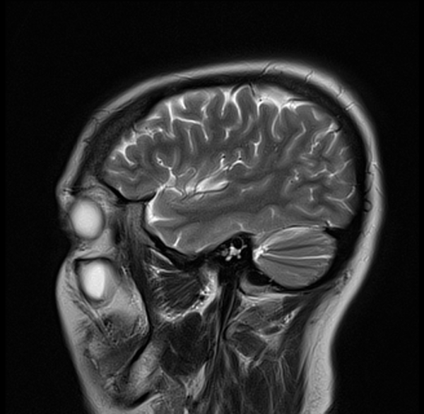 T2 MRI brain sagittal image 5