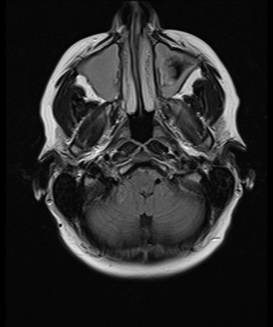 brain mri t2 flair axial images