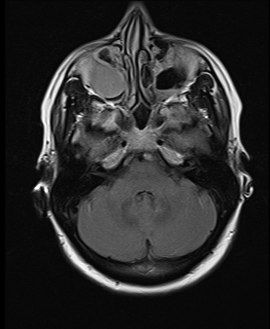 brain mri t2 flair axial images