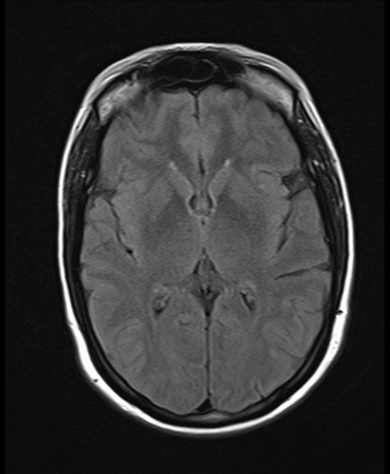 brain mri t2 flair axial images