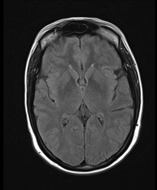 brain mri t1 axial post contrast image