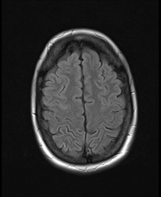 brain mri t2 flair axial images