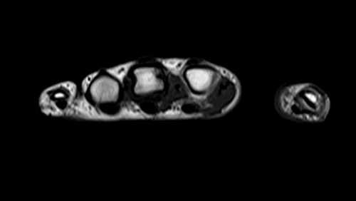 MRI hand axial t1 image