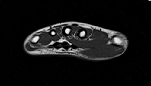 MRI hand axial t1 image