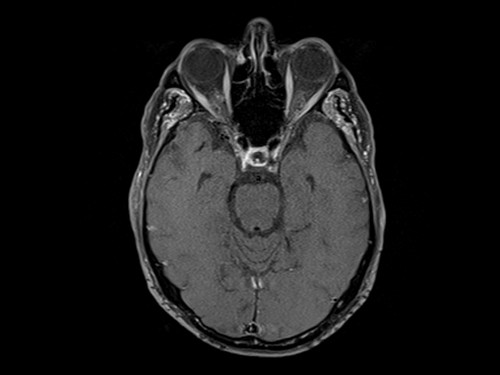 Malignant otitis externa (MOE) t1 fat sat post corntrast axial 5