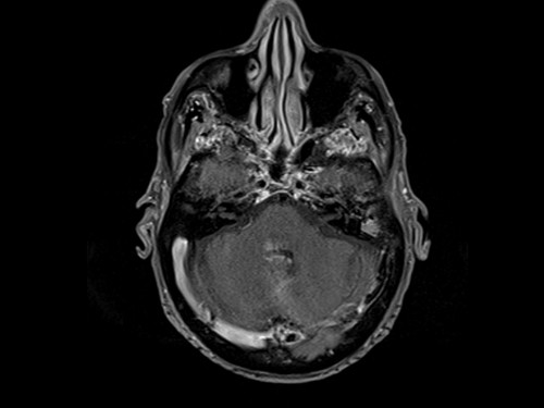 Malignant otitis externa (MOE) t1 fat sat post corntrast axial 4