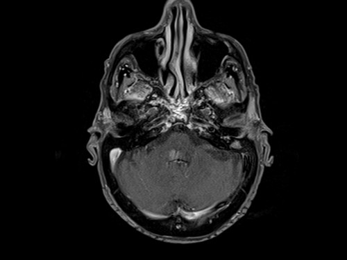 Malignant otitis externa (MOE) t1 fat sat post corntrast axial 3