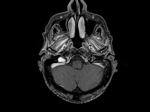 Malignant otitis externa (MOE) t1 fat sat post corntrast axial 2