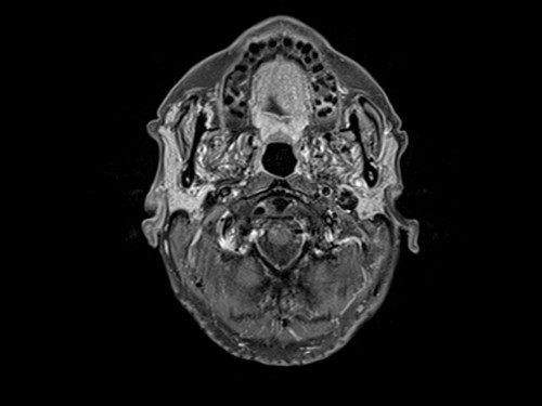 Malignant otitis externa (MOE) t1 fat sat post corntrast axial 1