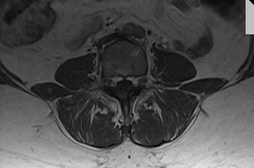 mri psoas muscle axial t1  image 