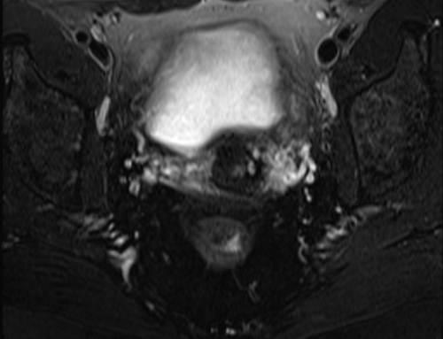 pelvis rectovaginal fistula axial  t2  fat sat image 