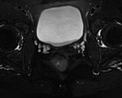 pelvis rectovaginal fistula axial  t2  fat sat image 