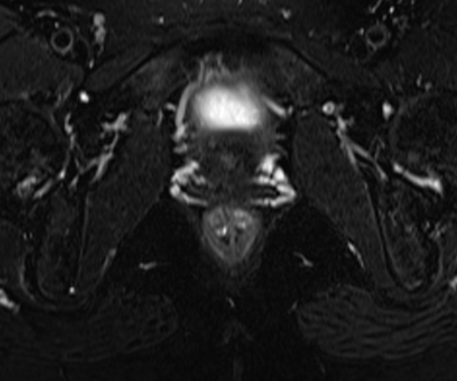 pelvis rectovaginal fistula axial  t2  fat sat image 