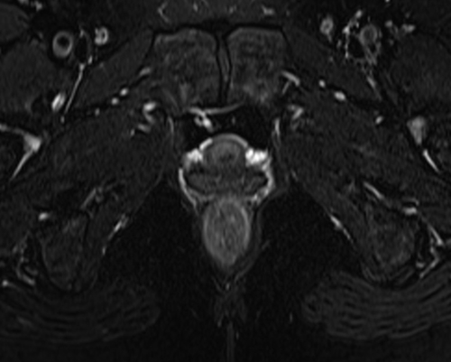 pelvis rectovaginal fistula axial  t2  fat sat image 