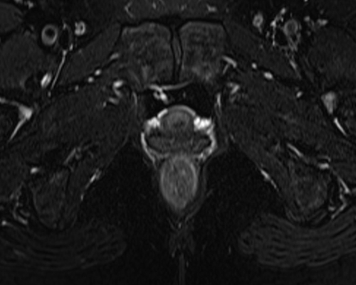 pelvis rectovaginal fistula axial  t2  fat sat image 