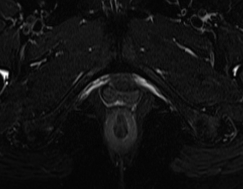 pelvis rectovaginal fistula axial  t2  fat sat image 