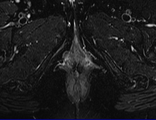 pelvis rectovaginal fistula axial  t2  fat sat image 