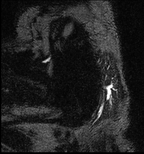 mri parotid sialography space 3D image