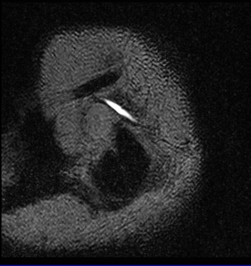 mri parotid sialography space 3D image