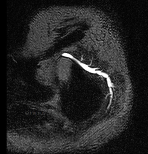 mri parotid sialography space 3D image