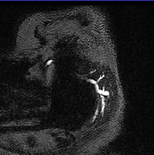 mri parotid sialography space 3D image